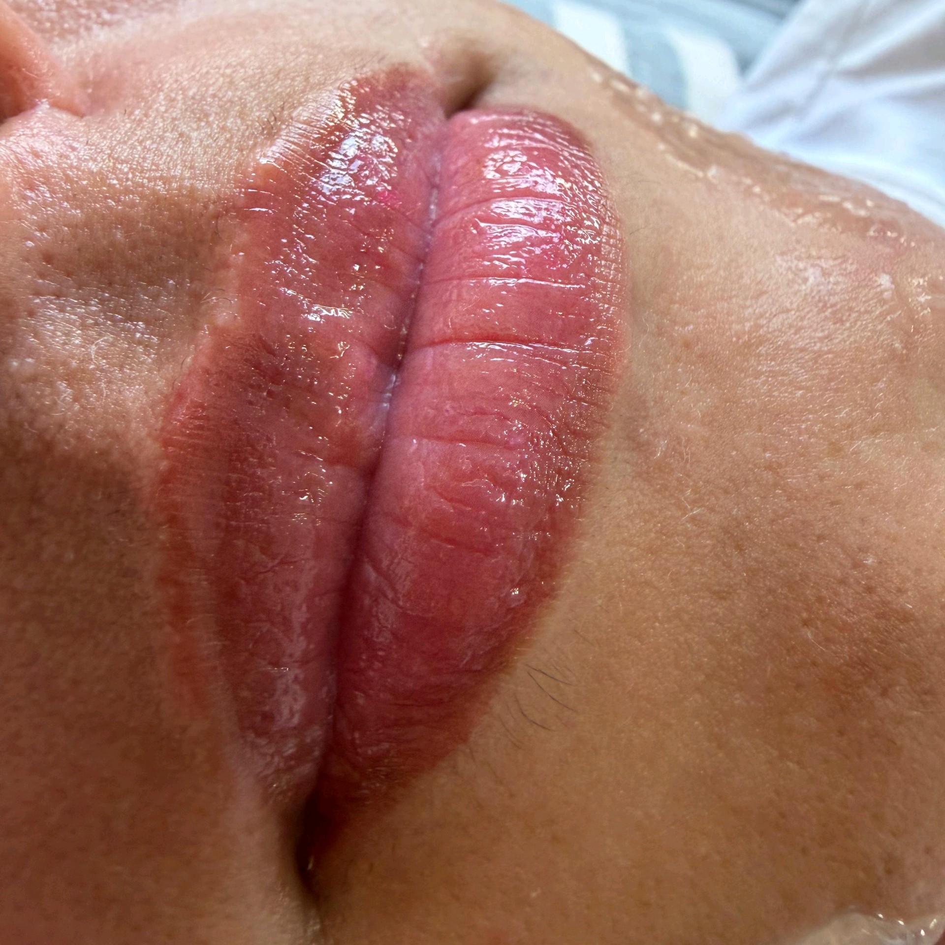 Hidra Lips