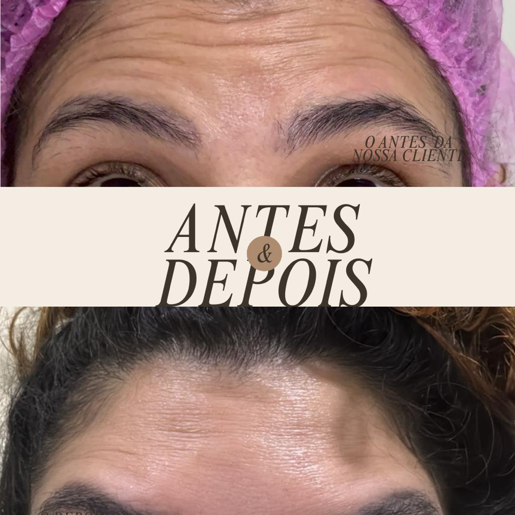 BOTOX DAY