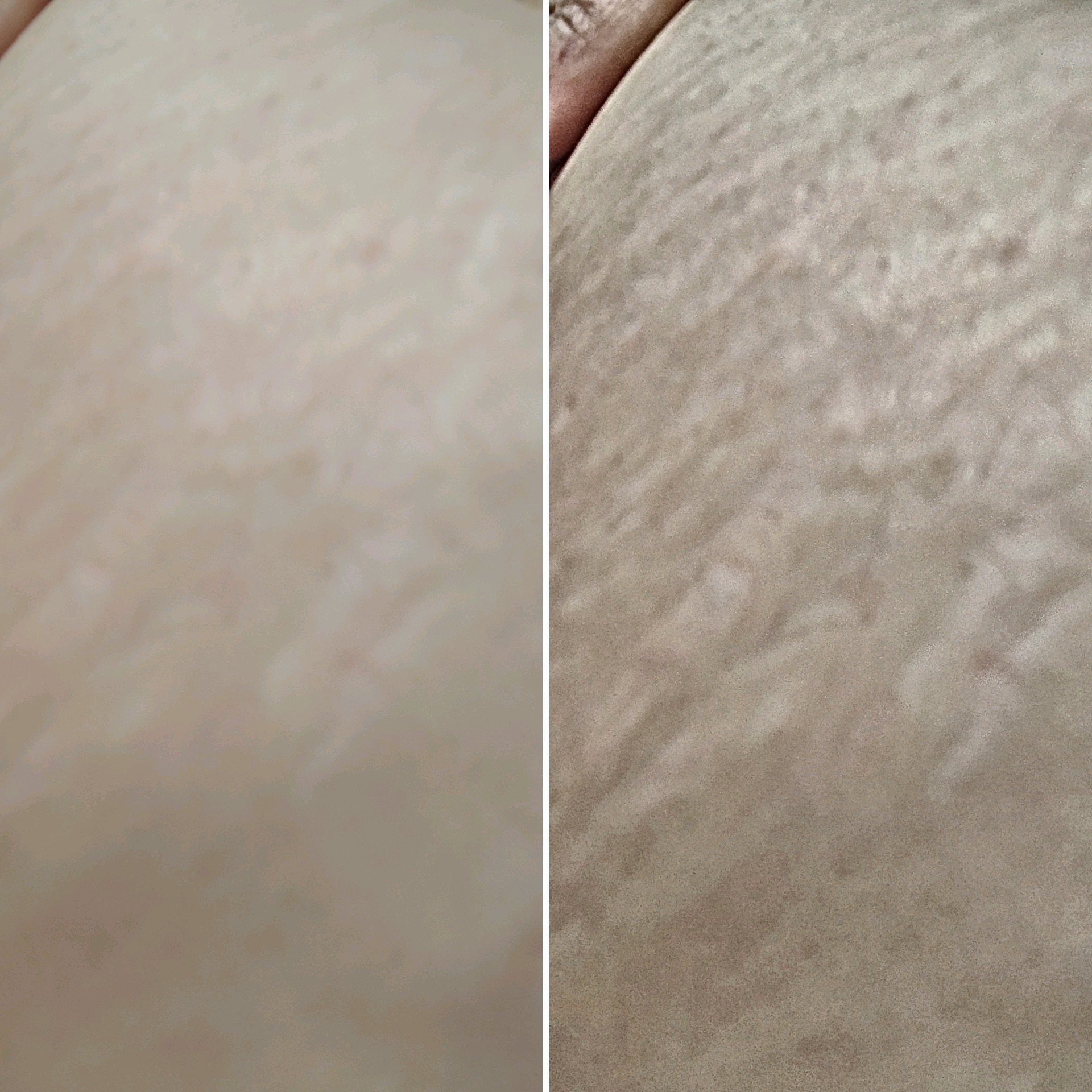 Tratamento de Premium de estrias com microagulhamento e jato de plasma. Sessões intercaladas por área..