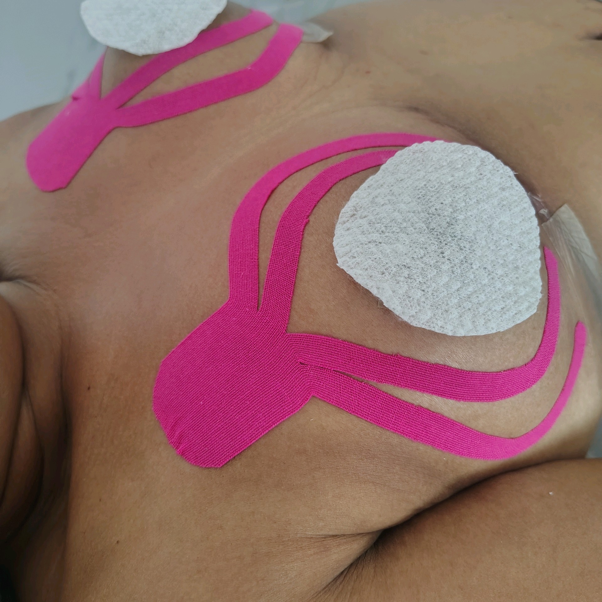 drenagem pós cirúrgica mamoplastia com ou sem prótese