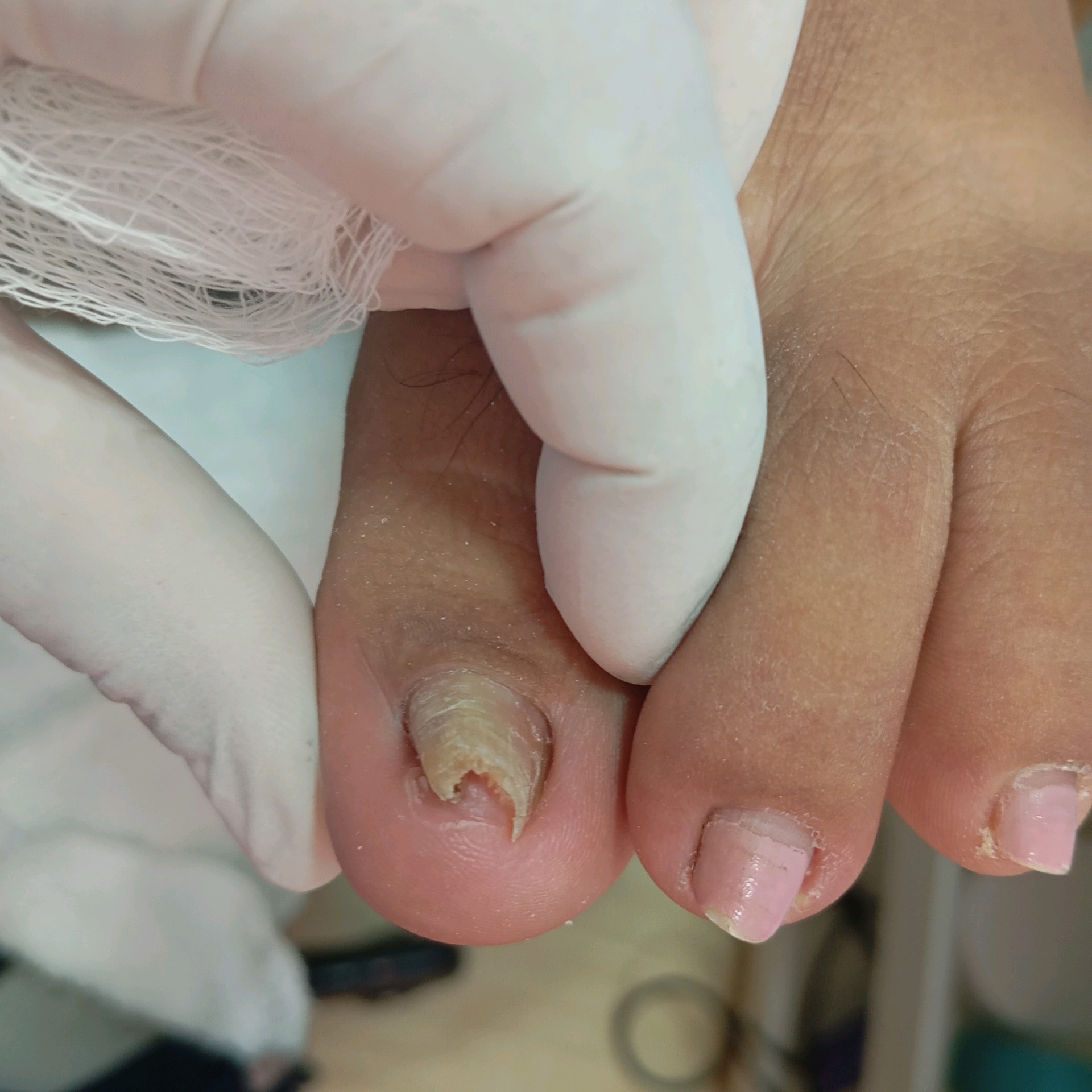 Correção de unhas com corte reto e órteses