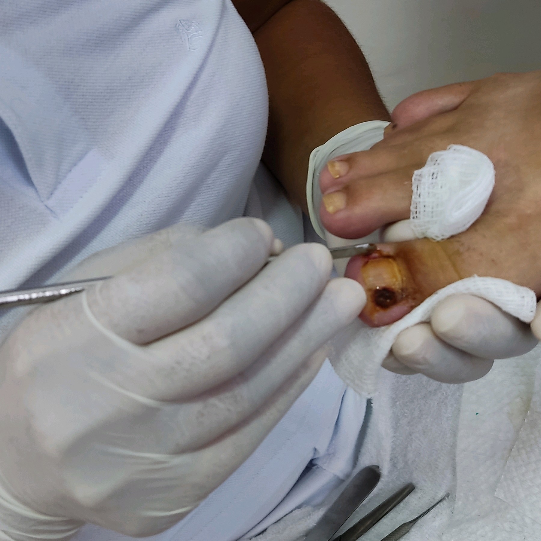 Espiculaectomia em um alox( não faço corte nem limpeza nas demais unhas nesse procedimento,somente o lesionado)