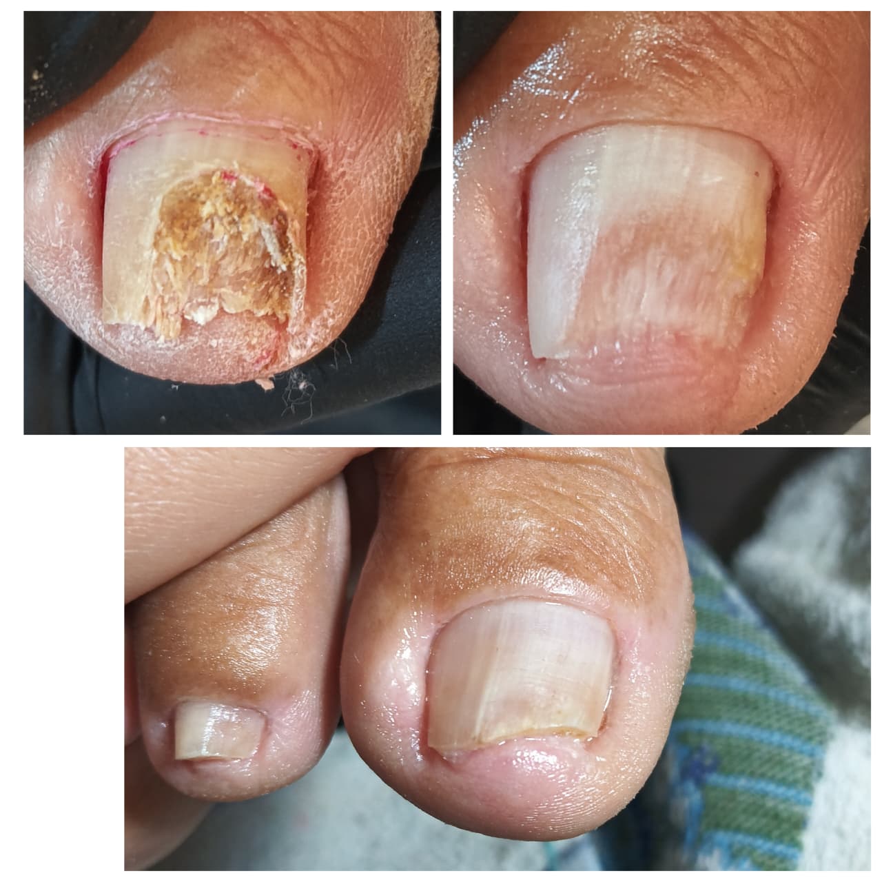 Micoses e fungos nas unhas (onicomicose)Limpeza da lâmina+ aplicação do tônico e o olhinho poderoso uso domiciliar.