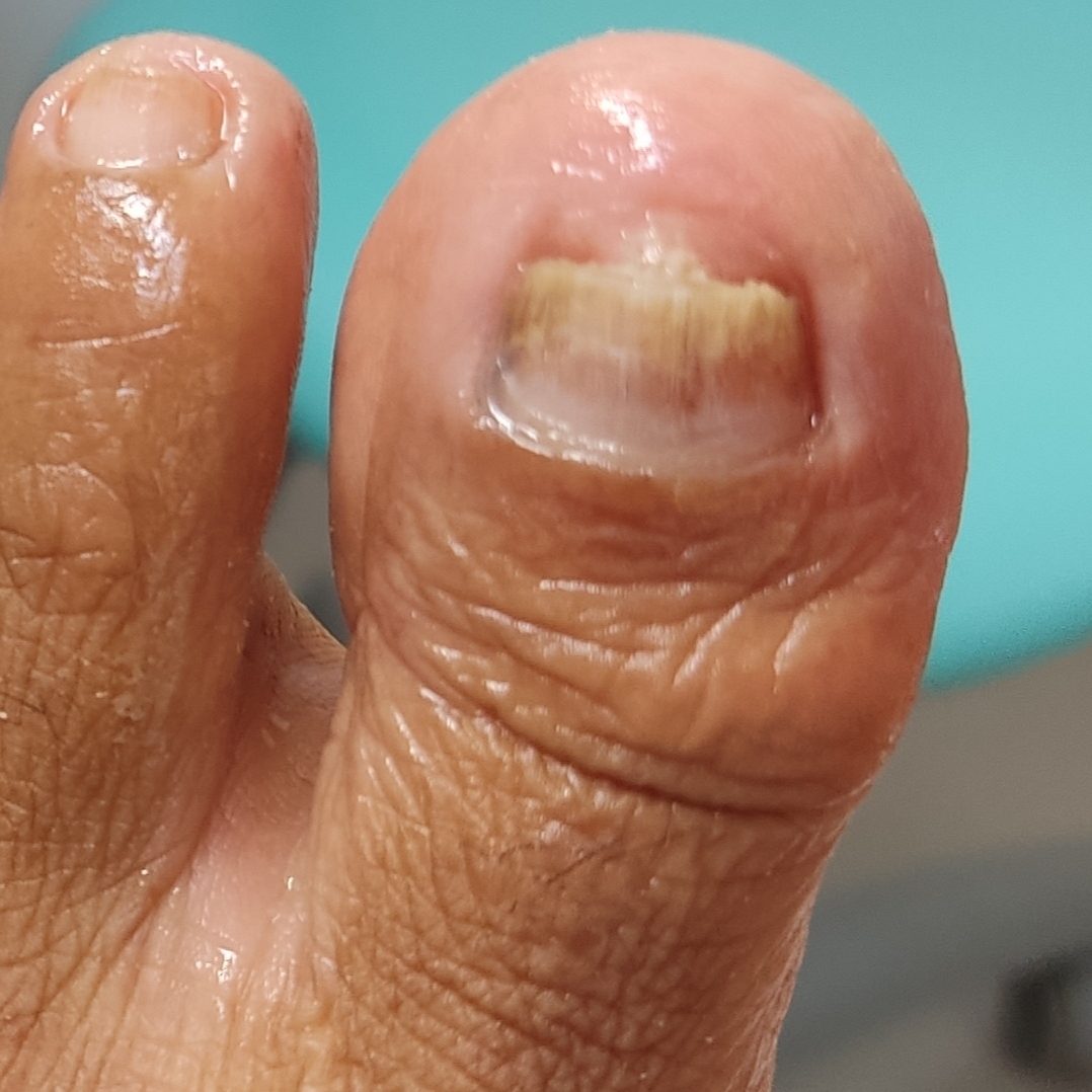 Retorno de órteses/ corte reto( colocou a órtese se necessário,e troca de órteses já aplicadas a 1 mês)Limpeza das unhas somente.