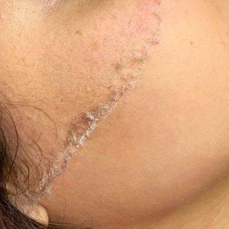 Dermaplaning
