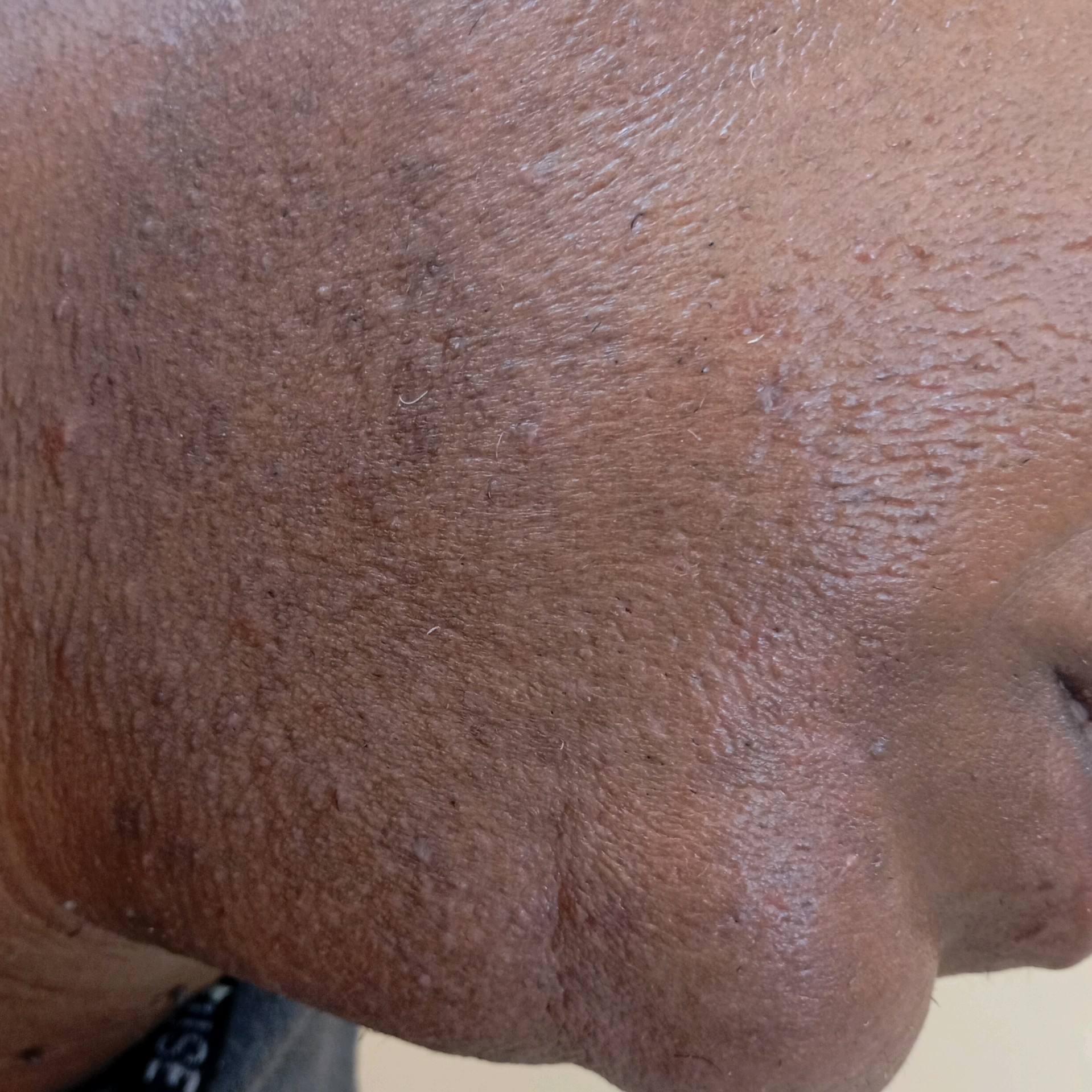 Epilação de Barba
