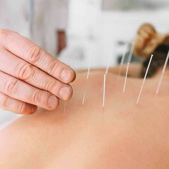 Acupuntura