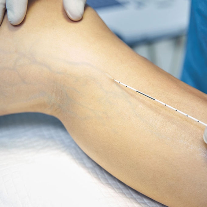 Escleroterapia Xô vasinhos