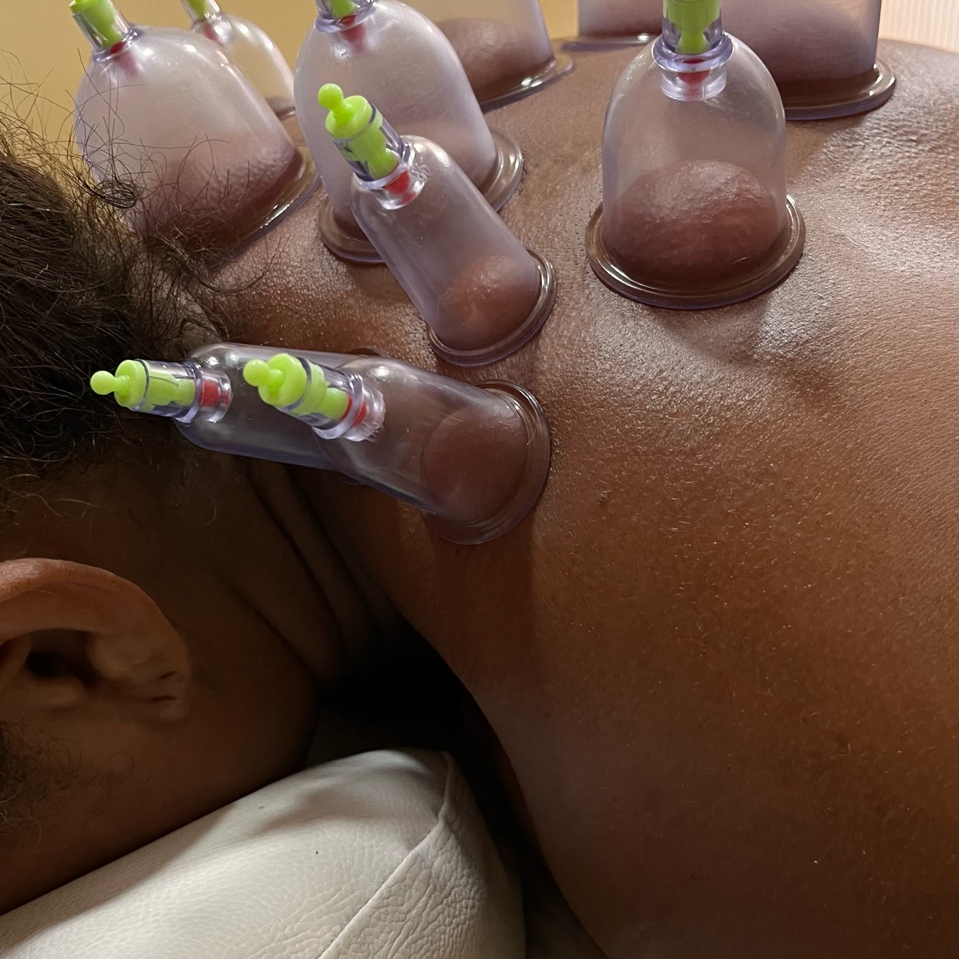 ventosa terapia+massagem