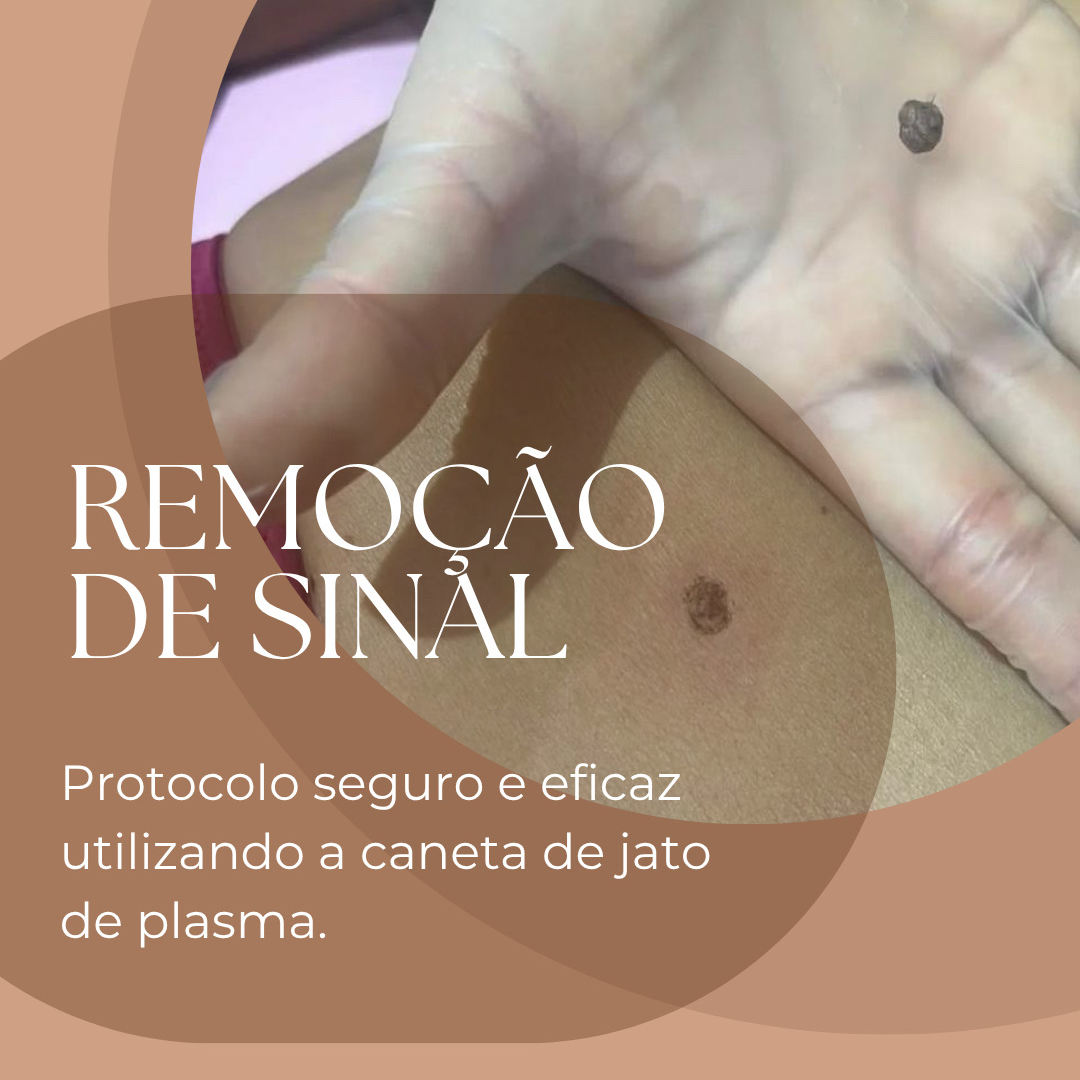 Remoção de sinal
