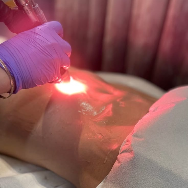 Laserterapia Local